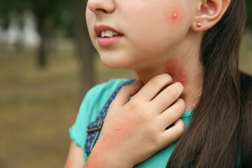Girl scratching neck with insect bites in park, closeup