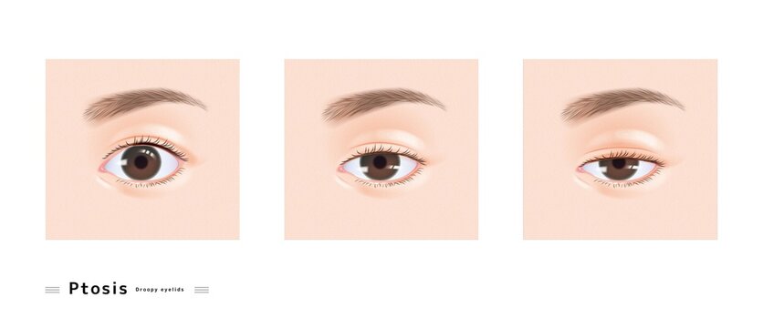 眼瞼下垂 女性 顔 目 眠たい まぶた 下垂 眼科 症例 イラスト