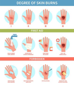 Burns degree. Thermal wound first aid, skin scalds and blisters emergency help. Treatment instruction thermic injury medical guide, information poster help steps flat vector infographic