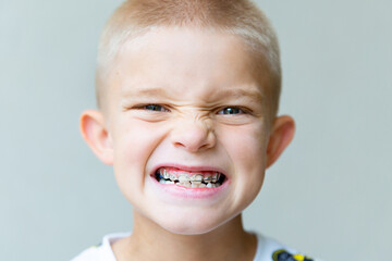 blond-haired boy grimaces, showing braces, close-up