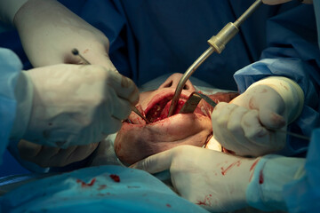 Maxillofaciial surgical operation close-up with different surgical instruments in patient's mouth
