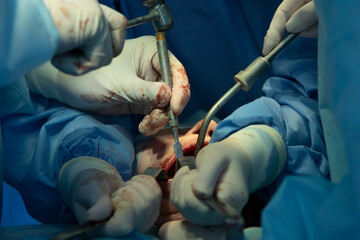 Maxillofaciial surgery closeup with surgical hummer an chisel usage