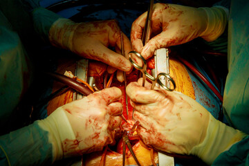 Patient during a heart surgery at a hospital in operating room