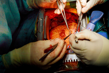 Coronary artery bypass grafting for open heart surgery