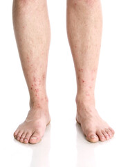Vertical closeup shot of male feet with red rashes