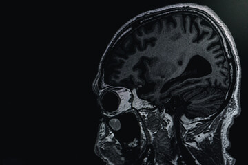 MRI of brain Dementia protocol with Alzheimer's disease  Take a picture from the computer 