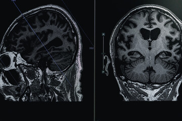 MRI of brain Dementia protocol with Alzheimer's disease  Take a picture from the computer 