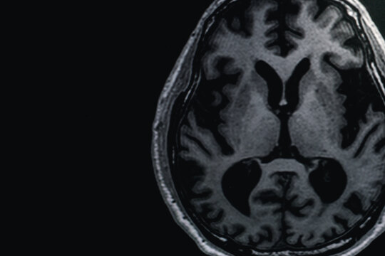 MRI of brain Dementia protocol with Alzheimer's disease  Take a picture from the computer 
