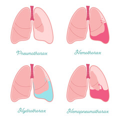Some types of pleural effusions. Abnormal gathering fluid or air pleural space. Hemothorax, pneumothorax, hemopneumothorax and hydrothorax also. Comparative scheme for patients or medical students