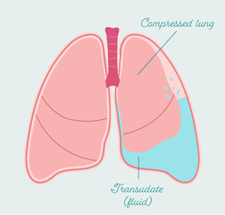 Hydrothorax - anatomical scheme in hand drawn style. Accumulation of transudate fluid in pleural cavity, type of pleural effusion. Patient-friendly infographic, vector medical scheme