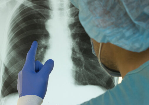 A doctor examines an X-ray of a patient s lung infected with covid-19 coronavirus,