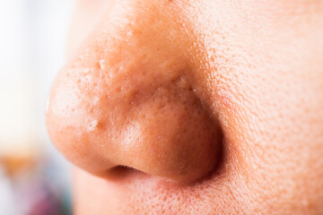 Closeup Asian young woman large pores have freckles cheek oily, acne pimple on nose, studio shot isolated on white background, Healthcare beauty skin face problem concept