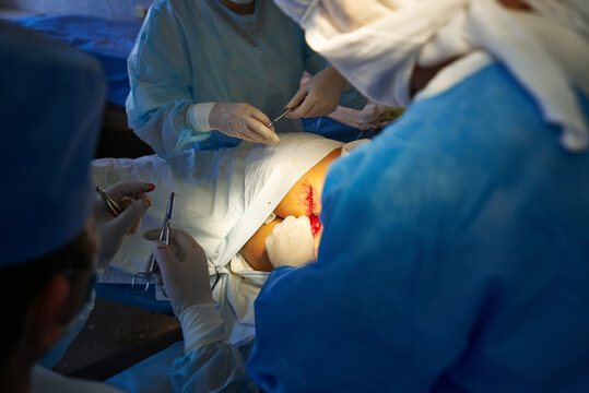 Surgery. The surgeon's assistant ties a ligature over the skin. Medical intervention.