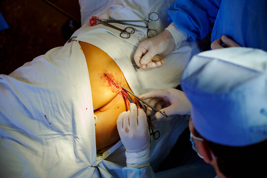 Surgery. The Surgeon Sews Up The Wound. View From Above.