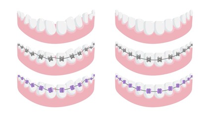 Lower jaw with healthy tooth and dental brace set. All type of metal, ceramic and invisible lingual orthodontic bracket system for teeth correction vector illustration isolated on white background - obrazy, fototapety, plakaty