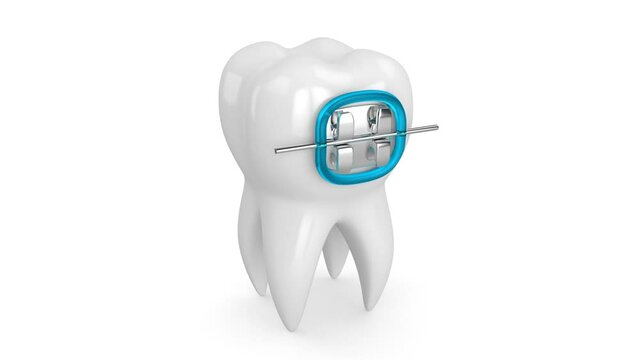 Tytuł: Tooth with dental orthodontic braces