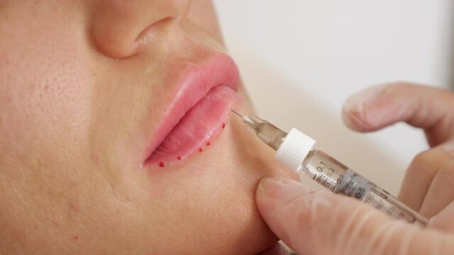 Close-up of a doctor making an injection into a woman's lower lip.
