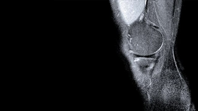 Magnetic resonance imaging (MRI) of left knee. Closed injury of the knee joint, with manifestations of arthrosis
