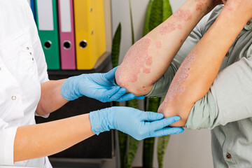 A dermatologist wearing gloves examines the skin of a sick patient. Examination and diagnosis of...