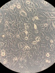 Cancer cells under the microscope