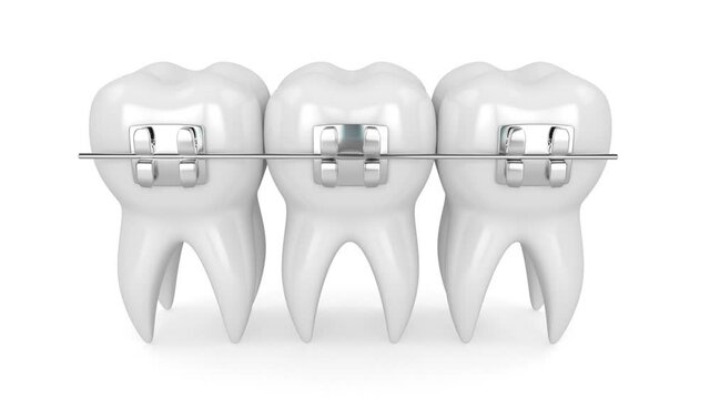  Teeth with dental orthodontic braces