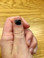 A black bruise under a finger nail of a Swedish child. Close up on the finger. Specifically the...