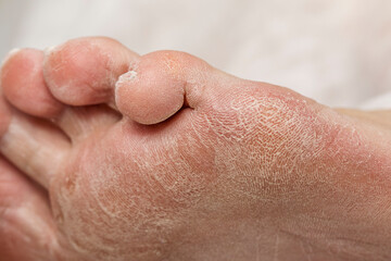 Problematic diabetic foot in a woman. Dry skin on the sole and cracked toes. Medical hardware pedicure in the salon.