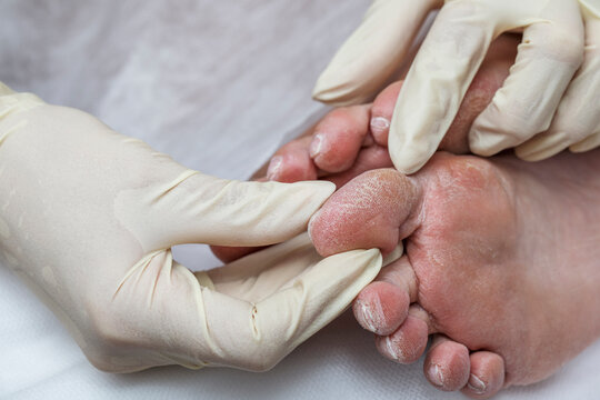 Problematic diabetic foot in a woman. Dry skin on the sole and cracked toes. Medical hardware pedicure in the salon.