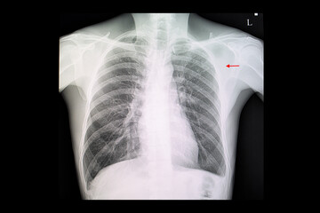  Chest x-ray film of a patient with  pulmonary tuberculosis