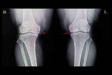 Xray film of both knees osteoarhthritis