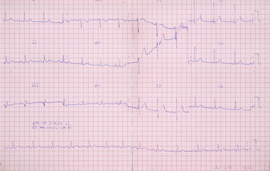 A real chart of an ECG (electrocardiogram, a trace, registered on paper, of the heart's electrical activity).
