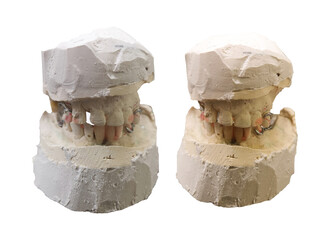 upper and lower mandible plaster prosthesis