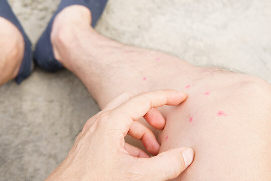Close up hand of a man scratching with itchiness on the red bumps on his legs that he've got bitten by Sandflies on the beach. Allergic reaction, Sandfly bites, Scratch, Scars, Repellents, Outdoor.