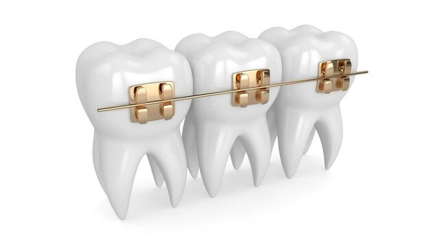  Teeth with  golden orthodontic braces