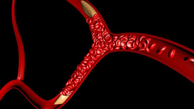 3d style clot stroke attack thrombosis medicine Europa 4k
