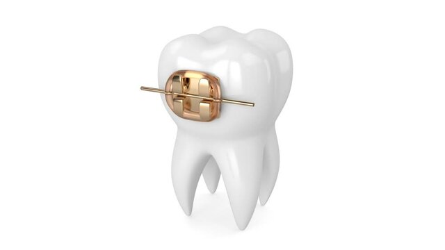 Tooth with  golden orthodontic braces
