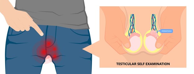 Testicular Disorder men vas pus tube male pain cyst test exam self cord vein sperm Acute blood semen tract penis viral virus tumor fluid testes pelvic sexual penile trauma system prostate testis