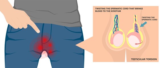 Testicular Disorder men vas pus tube male pain cyst test exam self cord vein sperm Acute blood semen tract penis viral virus tumor fluid testes pelvic sexual penile trauma system prostate testis