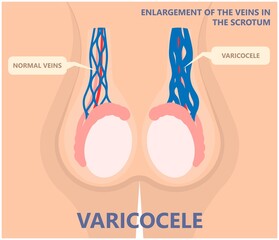 Testicular Disorder men vas pus tube male pain cyst test exam self cord vein sperm Acute blood semen tract penis viral virus tumor fluid testes pelvic sexual penile trauma system prostate testis