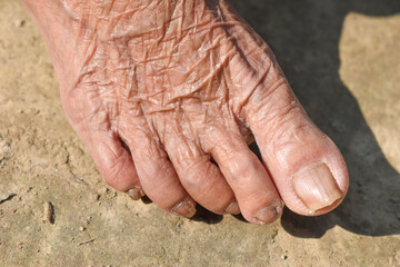 Fair toe of an old woman, her age is more than eighty .