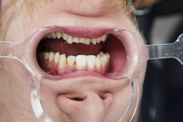 Dilator for the oral cavity. Preparation of the patient's oral cavity for the installation of...