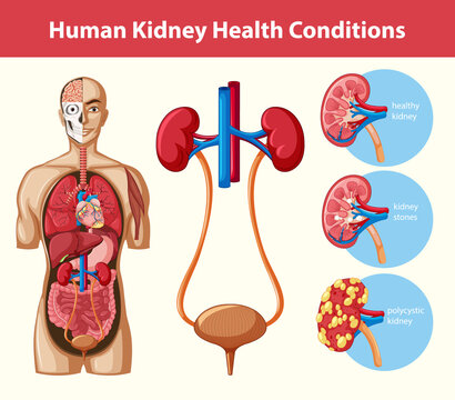 Human Kidney Health Conditions Infographic