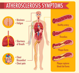 Stages of atherosclerosis information infographic