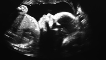 Tiny baby is turning in mother's belly during ultrasonic procedure.