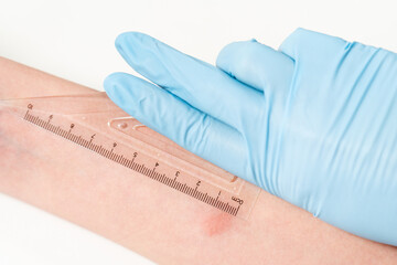 Closeup view photography of child's hand with red spot reaction to conducting Mantoux test after 72...