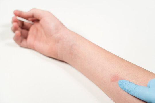 Closeup view photography of kids hand with red spot reaction to conducting Mantoux test after 72 hours from injection. Hand of nurse or doctor wearing blue glove.