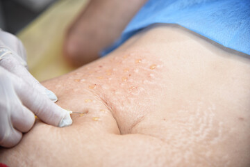 Plasmolifting. Injections for rejuvenation and skin regurgitation from human plasma. A modern beauty treatment