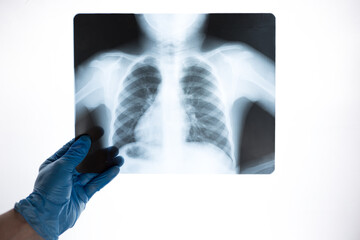 X-ray close-up of ribs and lungs in the hands of a doctor in blue gloves. The doctor examines the picture