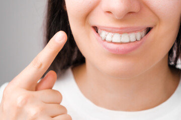 Happy woman with a perfect smile shows with finger on transparent aligners on her teeth © vladim_ka
