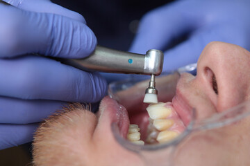 A dentist cleans the patient's teeth. Preparation of the oral cavity for the installation of braces. Unrecognizable doctor. The concept of health. Hands in protective gloves. Macro photo.